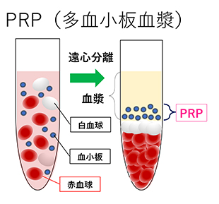 prp